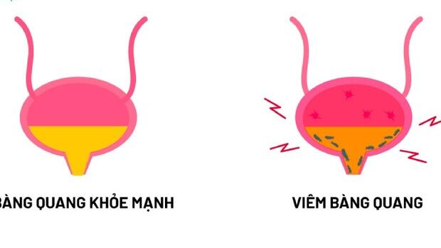 ĐIỀU TRỊ VIÊM BÀNG QUANG CẤP