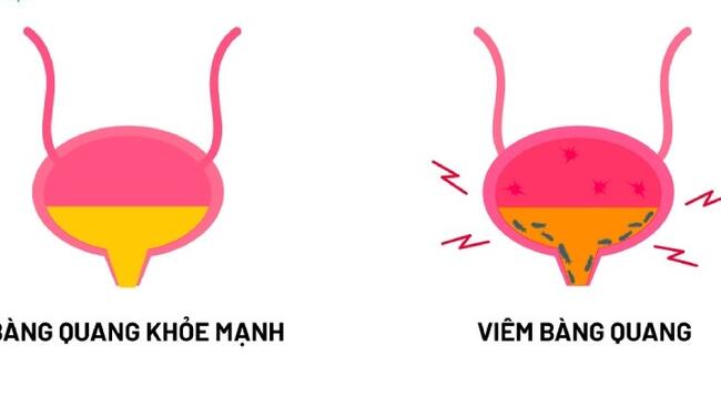 ĐIỀU TRỊ VIÊM BÀNG QUANG CẤP