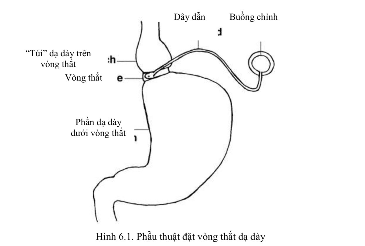 Phẫu thuật đặt vòng thắt dạ dày